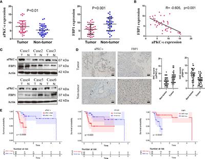 Loss of FBP1 by aPKC-ι/Snail Pathway-Mediated Repression Promotes Invasion and Aerobic Glycolysis of Intrahepatic Cholangiocarcinoma